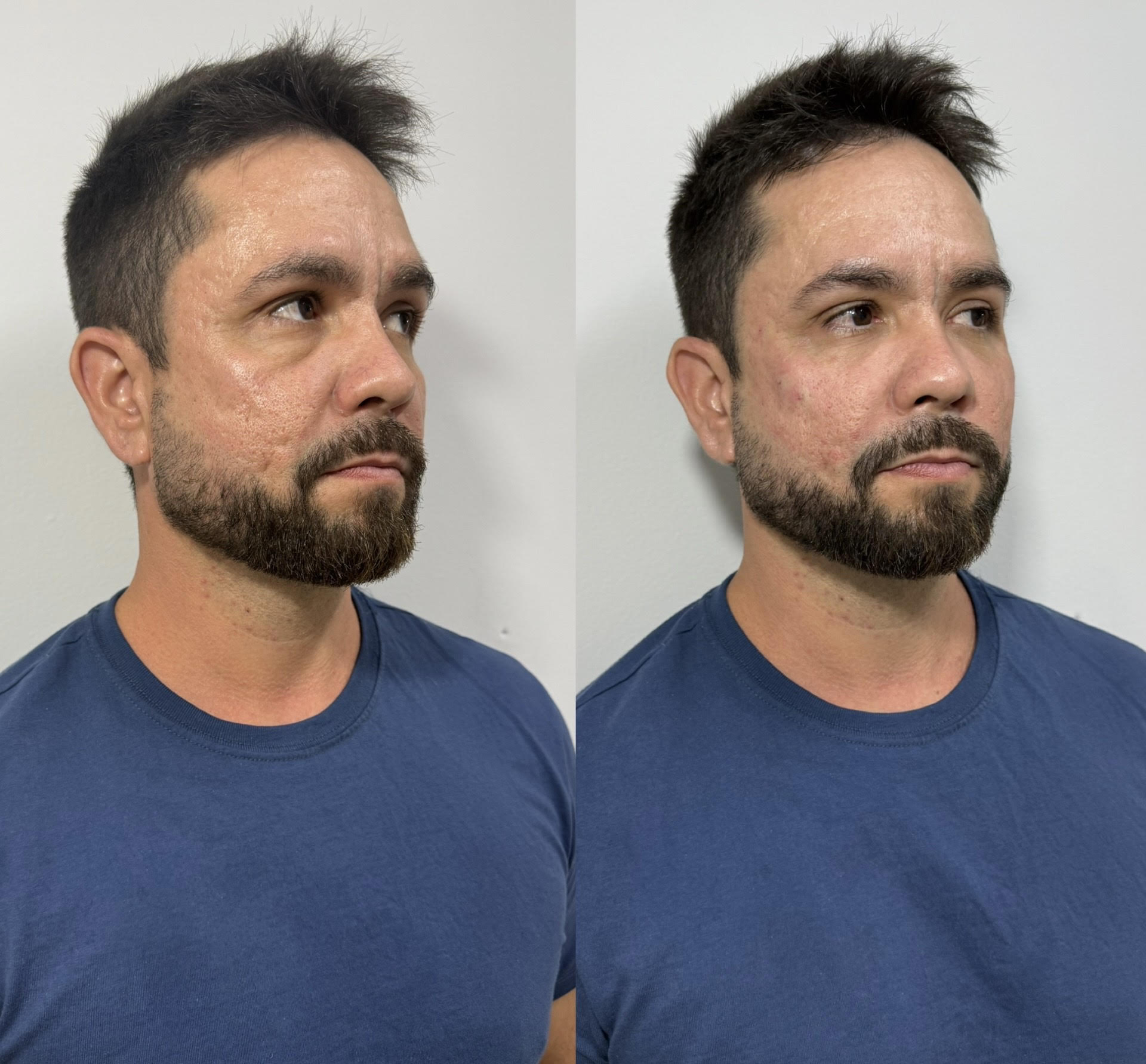 Resultado de Olheiras